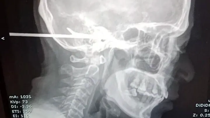 Fisherman harpooned after argument over catch size